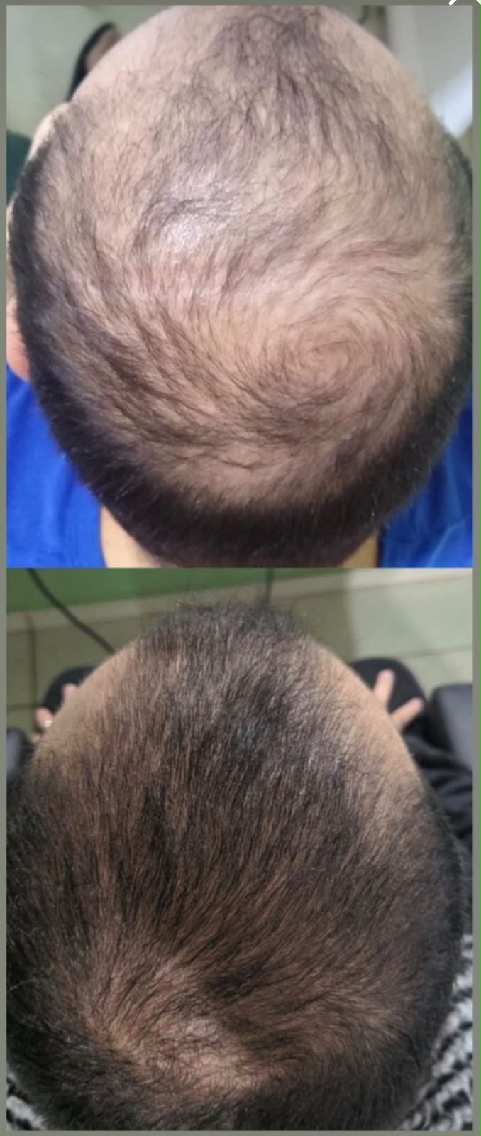 Antes e depois de tratamento capilar 3